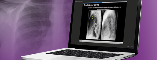 thoracic oncology resources on a laptop