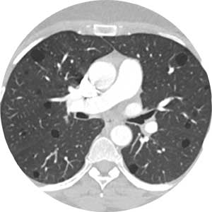 Lymphangioleiomyomatosis