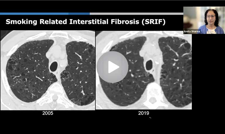 Smoking-Related ILD