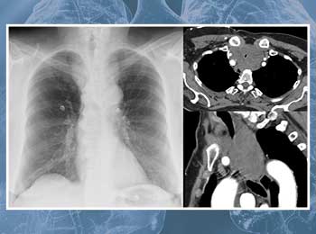 Central Airway Obstruction Guideline