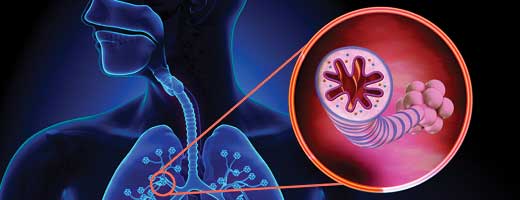 Biologic Management in Severe Asthma for Adults artwork