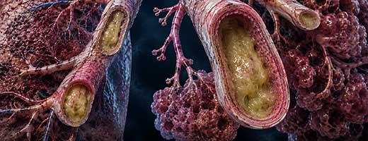 Management of Adult Bronchiectasis guideline imagery