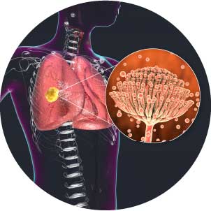 Graphic of aspergillus fungi in lungs