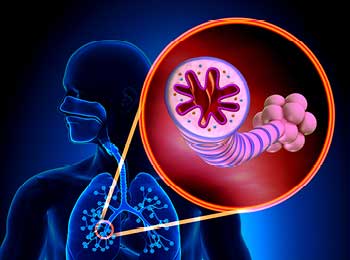 Asthma in the lungs